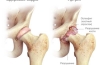 Artritis pri psih: zdravljenje